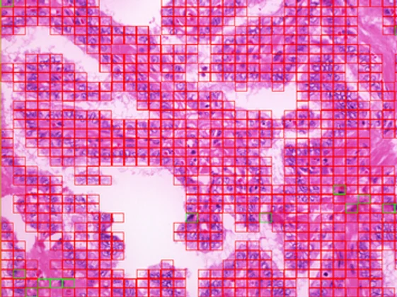 The same slide with the model's per-tile classification grid, malignant regions marked