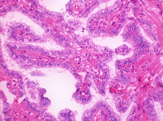 Thyroid histopathology slide, hematoxylin and eosin stain, before classification